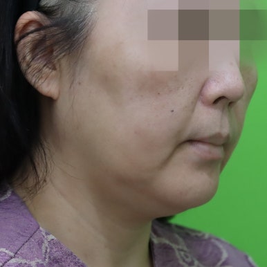 Early Swelling Changes After Facelift (Day 3, 1 Week, 2 Weeks) image 2