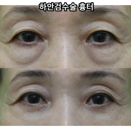 하안검수술흉터, 이 원본 사진에서 잘 보이나요? 관련 이미지 17