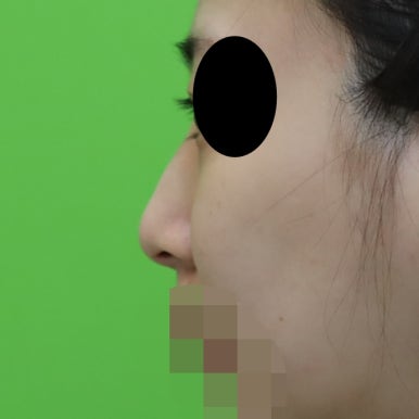 매부리코교정, 코뼈 제거 없이 재배치로 해결 관련 이미지 13