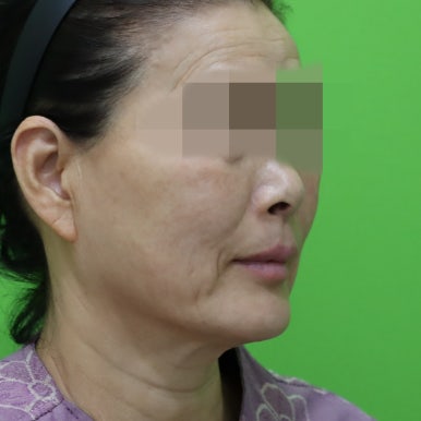 안면거상술, 이중턱 근육 묶기 후 회복 기간 관련 이미지 27