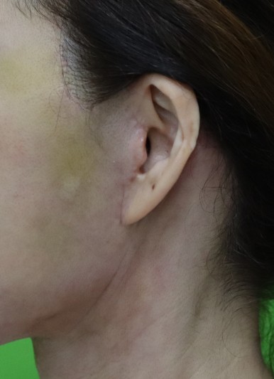 Facelift Scars, the Reason They Look Seamless After 6 Months image 14
