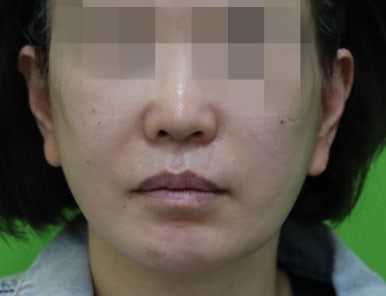 안면거상 재수술, 왜 3년전 수술이 효과가 없었을까? 관련 이미지 11