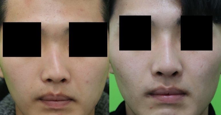 Crooked Nose Surgery: If You Don’t Know This, You’ll Need Revision Surgery Again. image 8