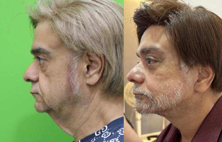 Facelift Review: Why the Neck Lift Technique Matters image 13