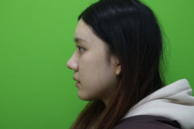 복코성형, 연예인 지망생의 리얼 후기 관련 이미지 7