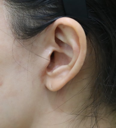 몸은 말랐는데 이중턱살제거가 시급할 때? 관련 이미지 25