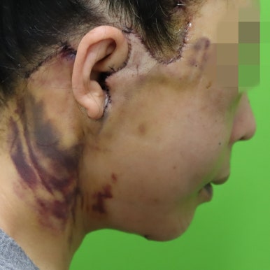 Early Swelling Changes After Facelift (Day 3, 1 Week, 2 Weeks) image 8