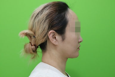 이중턱살제거, 마른 몸에 이중턱만 고민이라면? 관련 이미지 16