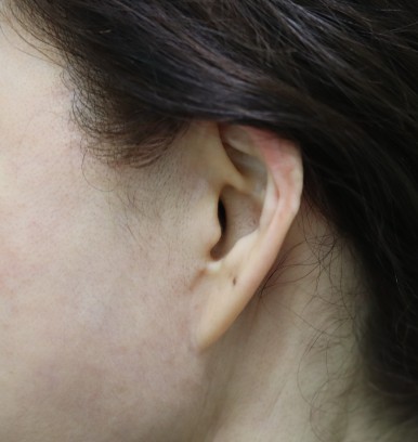Facelift Scars, the Reason They Look Seamless After 6 Months image 23