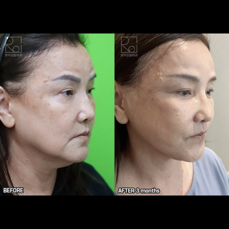 Facelift Review: A Woman in Her Early 60s Looks More Than 10 Years Younger image 9