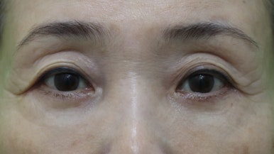하안검수술흉터, 이 원본 사진에서 잘 보이나요? 관련 이미지 9
