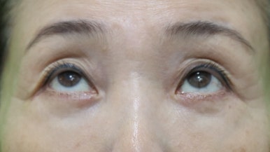 하안검수술흉터, 이 원본 사진에서 잘 보이나요? 관련 이미지 11