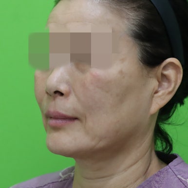 안면거상술, 이중턱 근육 묶기 후 회복 기간 관련 이미지 21