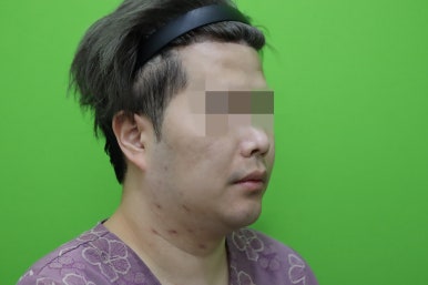 Double Chin Muscle Tying Swelling, Day 1 Appearance image 13