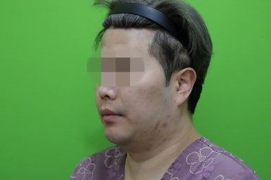 Double Chin Muscle Tying Swelling, Day 1 Appearance image 2