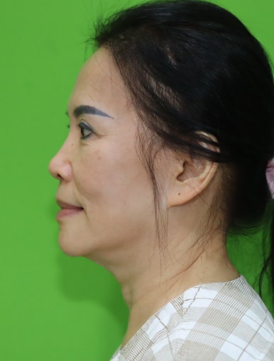 Revision Facelift 3 Months Later, Including Removal of the Existing Scar image 6
