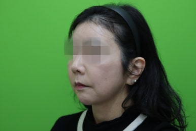 50대 여성 안면거상술 및 이중턱 근육묶기 후기 관련 이미지 10