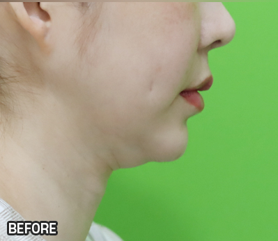 Facelift Results: Can They Be Good Even at a Young Age? image 3
