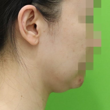 몸은 말랐는데 이중턱살제거가 시급할 때? 관련 이미지 15