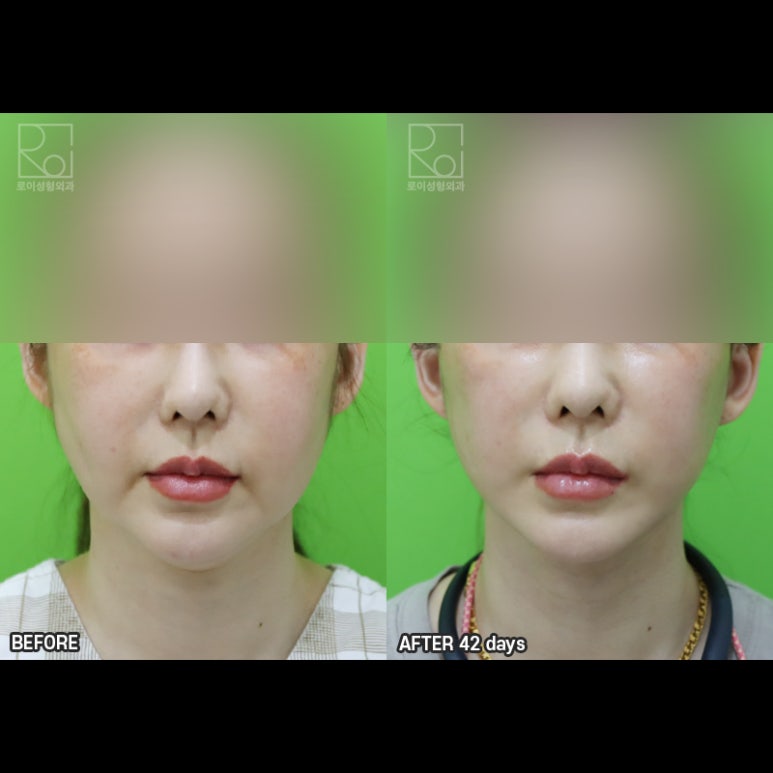 Facelift Results: Can They Be Good Even at a Young Age? image 4