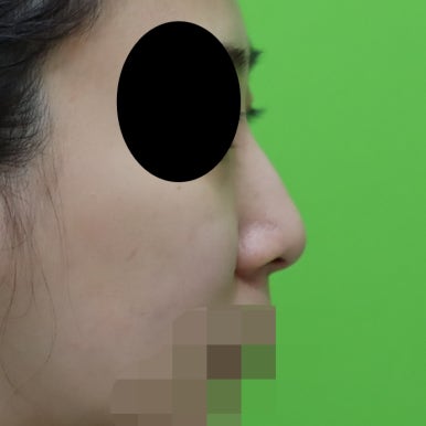 매부리코교정, 코뼈 제거 없이 재배치로 해결 관련 이미지 9