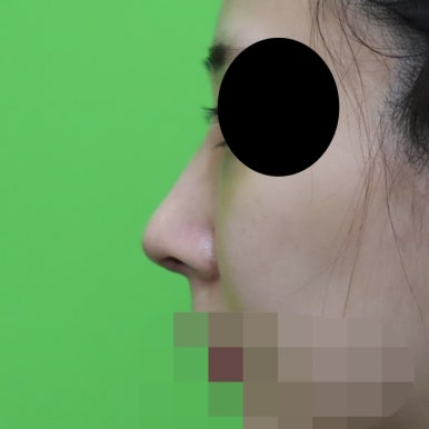 매부리코교정, 코뼈 제거 없이 재배치로 해결 관련 이미지 6