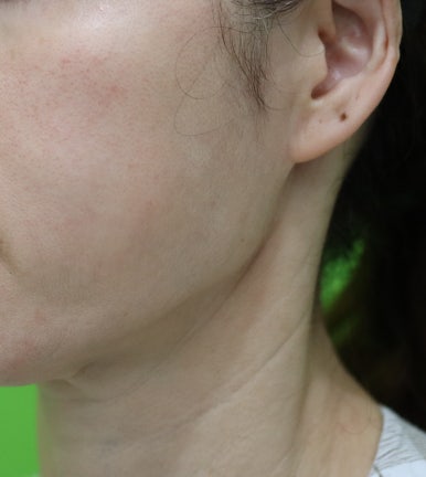 Facelift Scars, the Reason They Look Seamless After 6 Months image 3