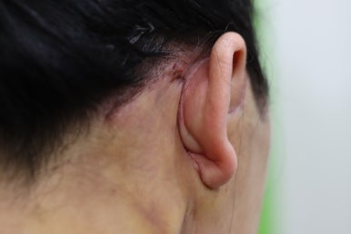 Early Swelling Changes After Facelift (Day 3, 1 Week, 2 Weeks) image 22