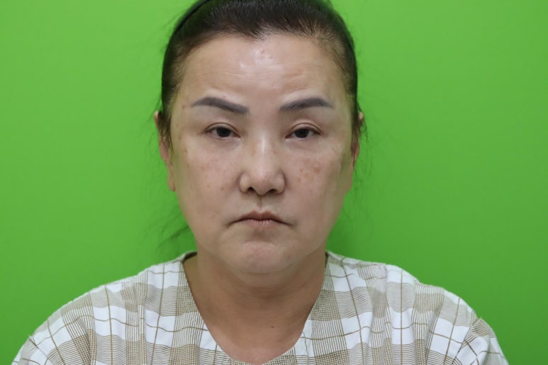 Facelift Review: A Woman in Her Early 60s Looks More Than 10 Years Younger image 1
