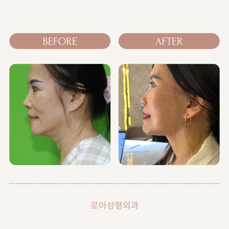 Revision Facelift 3 Months Later, Including Removal of the Existing Scar image 19
