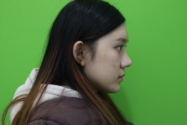 복코성형, 연예인 지망생의 리얼 후기 관련 이미지 15