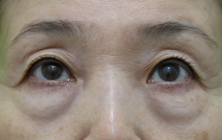 하안검수술흉터, 이 원본 사진에서 잘 보이나요? 관련 이미지 2