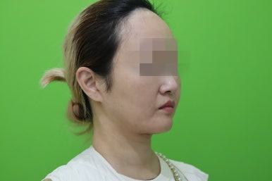 이중턱살제거, 마른 몸에 이중턱만 고민이라면? 관련 이미지 14