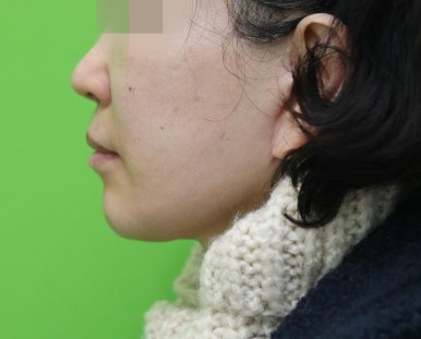 안면거상 재수술, 왜 3년전 수술이 효과가 없었을까? 관련 이미지 24