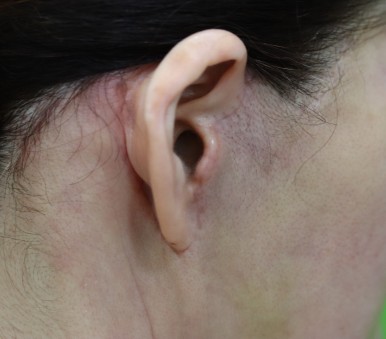 Facelift Scars, the Reason They Look Seamless After 6 Months image 15