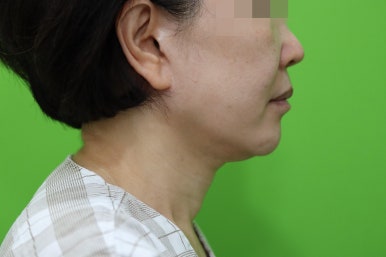 안면거상 재수술, 왜 3년전 수술이 효과가 없었을까? 관련 이미지 6