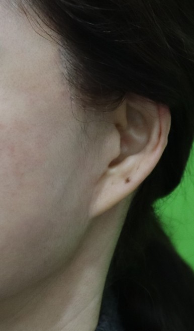 Facelift Scars, the Reason They Look Seamless After 6 Months image 21