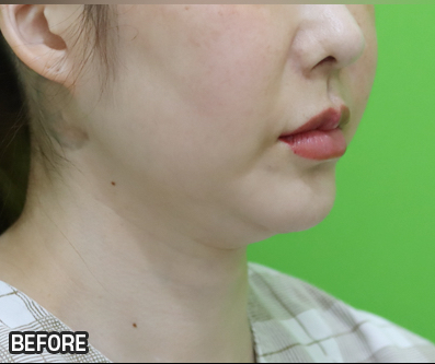 Facelift Results: Can They Be Good Even at a Young Age? image 2