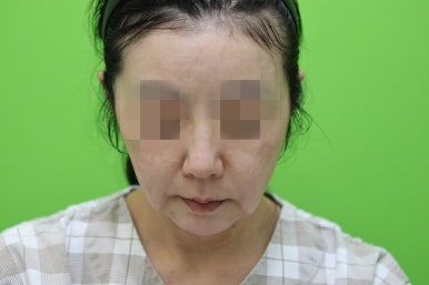 50대 여성 안면거상술 및 이중턱 근육묶기 후기 관련 이미지 7