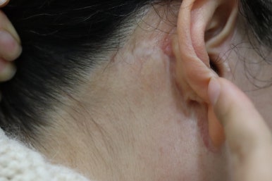 안면거상 재수술, 왜 3년전 수술이 효과가 없었을까? 관련 이미지 30