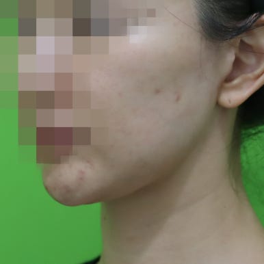 몸은 말랐는데 이중턱살제거가 시급할 때? 관련 이미지 20
