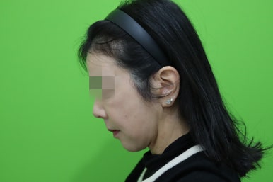 50대 여성 안면거상술 및 이중턱 근육묶기 후기 관련 이미지 14