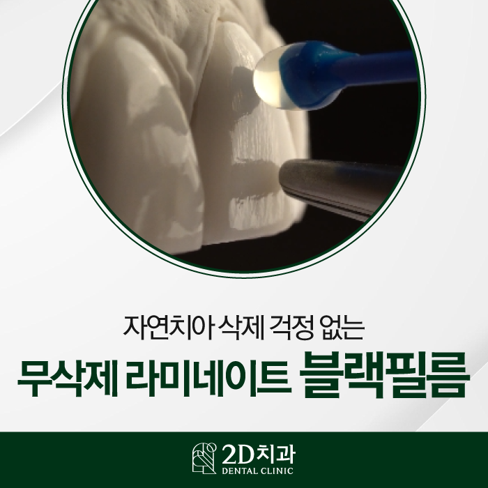 자연스러운 앞니라미네이트를 위한 방법 관련 이미지 1