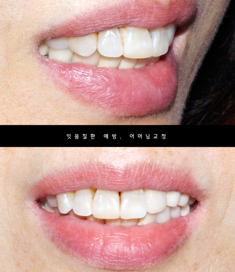 2D치과(투디치과) 교정일기 ㅣ 잇몸질환 예방되는 치아교정(feat.어머님교정) 관련 이미지 1