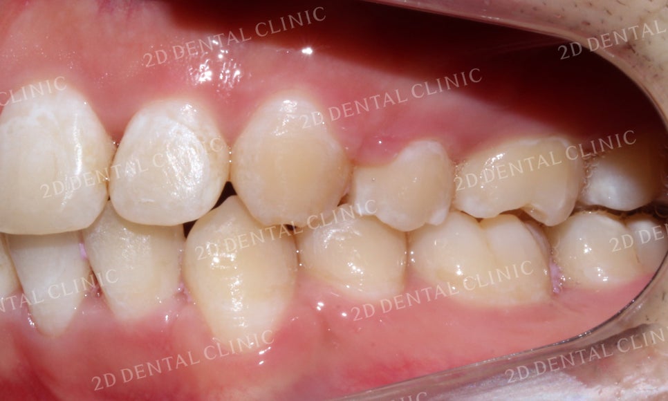 돌출앞니 교정, 튀어나온 입을 넣어보자! by.투디치과(2D치과) 관련 이미지 25