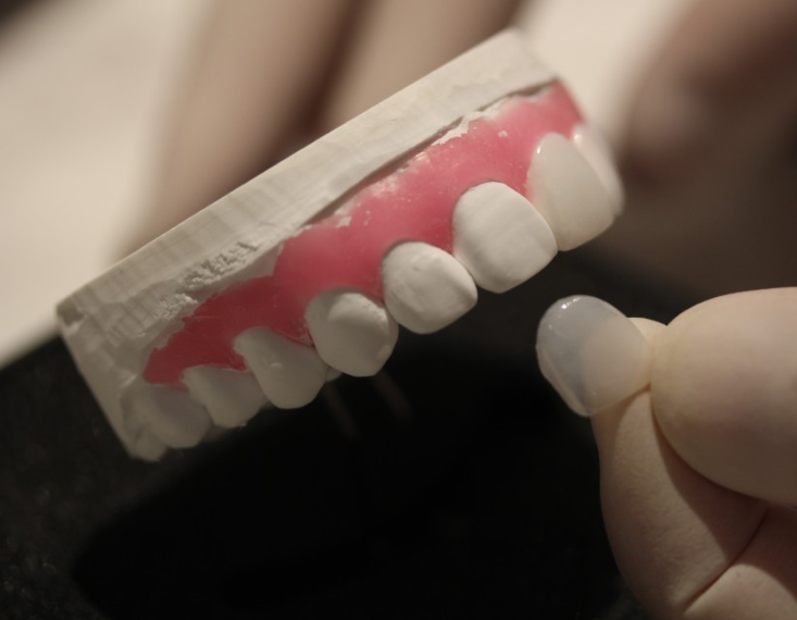 라미네이트 치실 시술 후 치아관리방법 관련 이미지 4