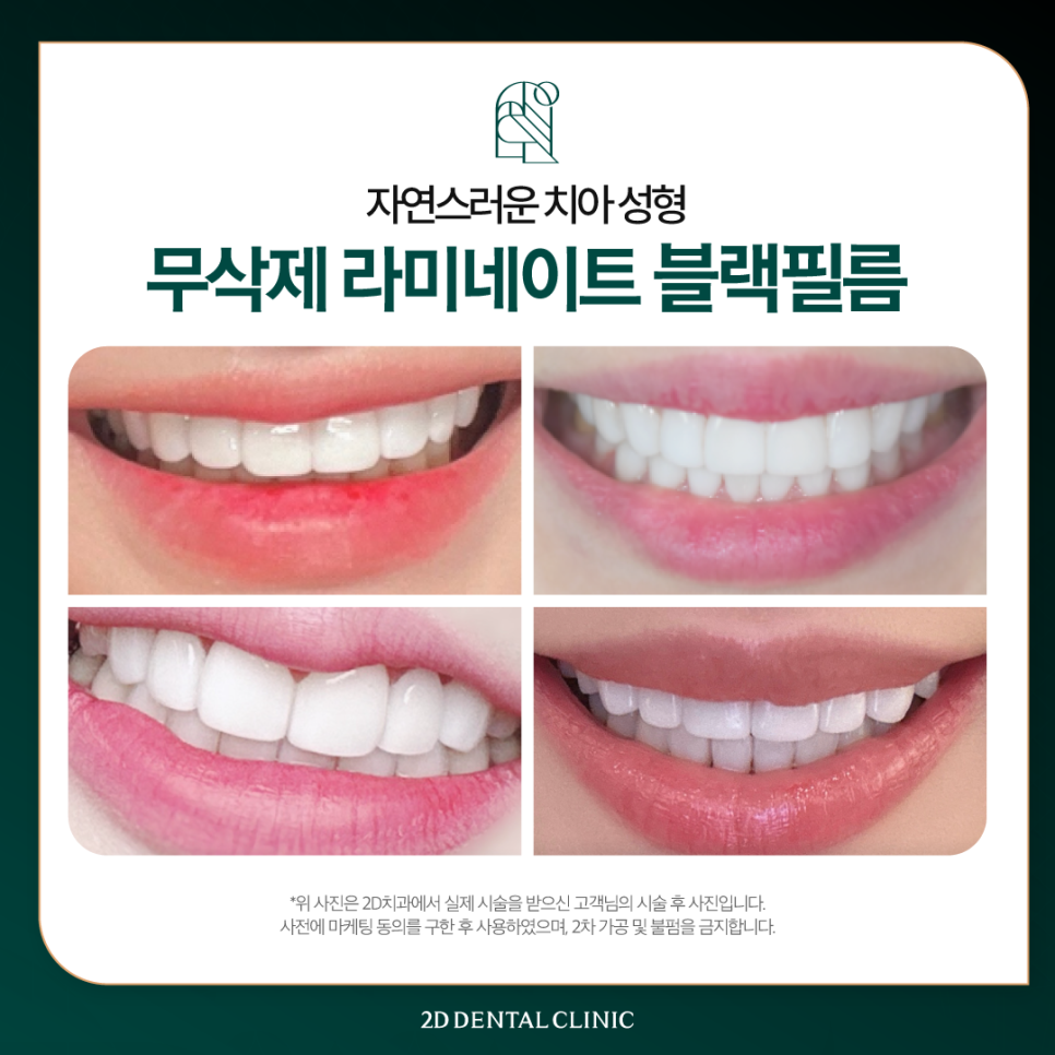압구정치과 치아성형비용 무삭제 블랙필름 가격과 장점 관련 이미지 6