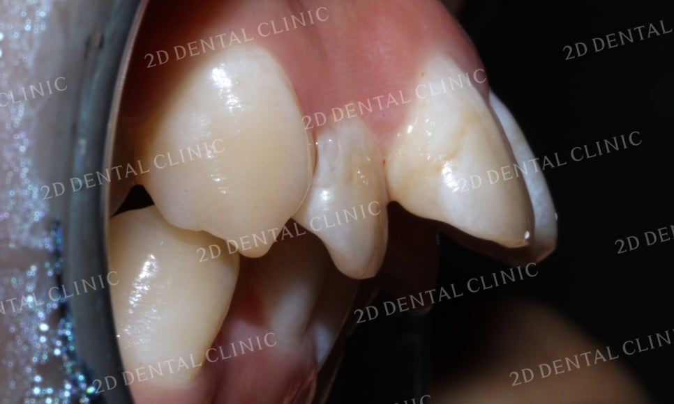 돌출앞니 교정, 튀어나온 입을 넣어보자! by.투디치과(2D치과) 관련 이미지 6