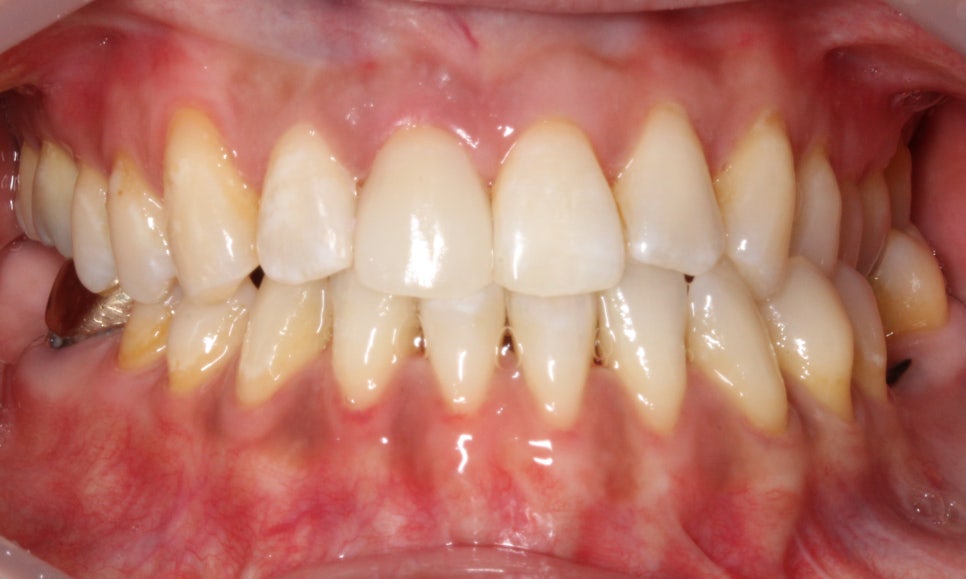 2D(투디)치과 블링스, 추천합니다!(깨진 앞니, 돌출앞니, 벌어진 앞니, 치아 노후, 치아 변색) 관련 이미지 3