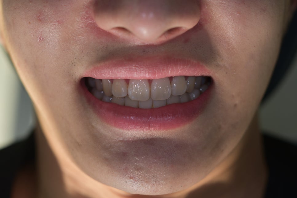 라미네이트치과 알아본다면? 관련 이미지 5